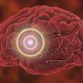 Treating Migraines, Brain Fog and Dizziness